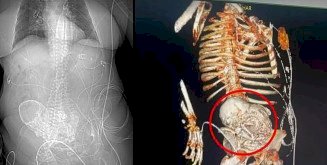 Idosa de 81 anos carregava feto calcificado por 56 anos no MS